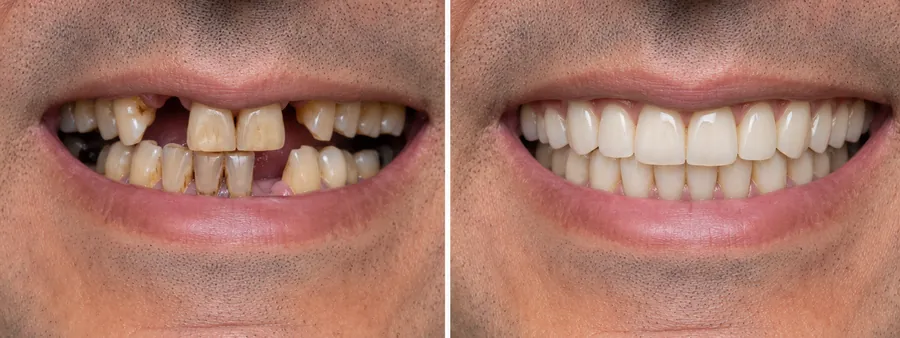 Illustrative before and after smile comparison: discoloured, crowded and missing teeth on the left, a restored upper and lower arch on the right.