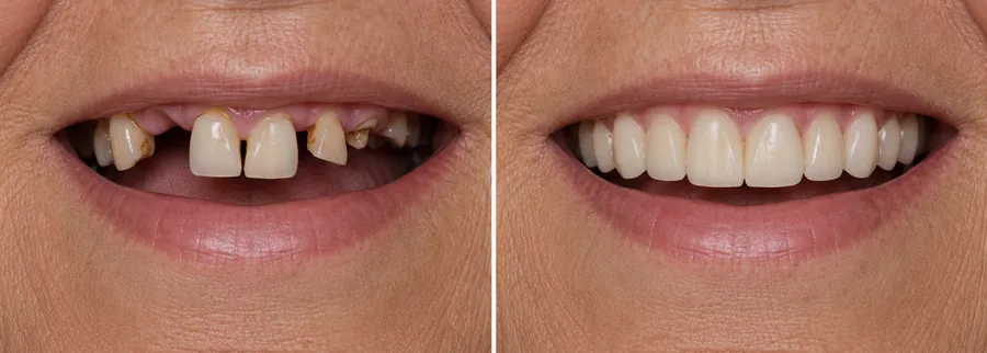 Illustrative before and after smile comparison: worn, chipped and missing upper teeth on the left, a full upper arch on the right.